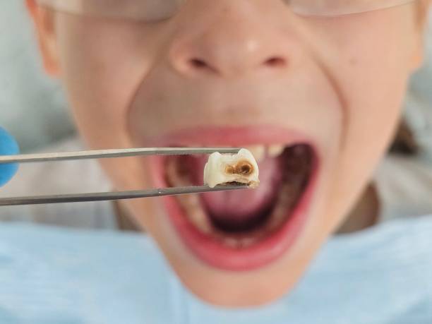 Best Emergency Dental Care for Broken or Chipped Teeth in Edmonton, KY